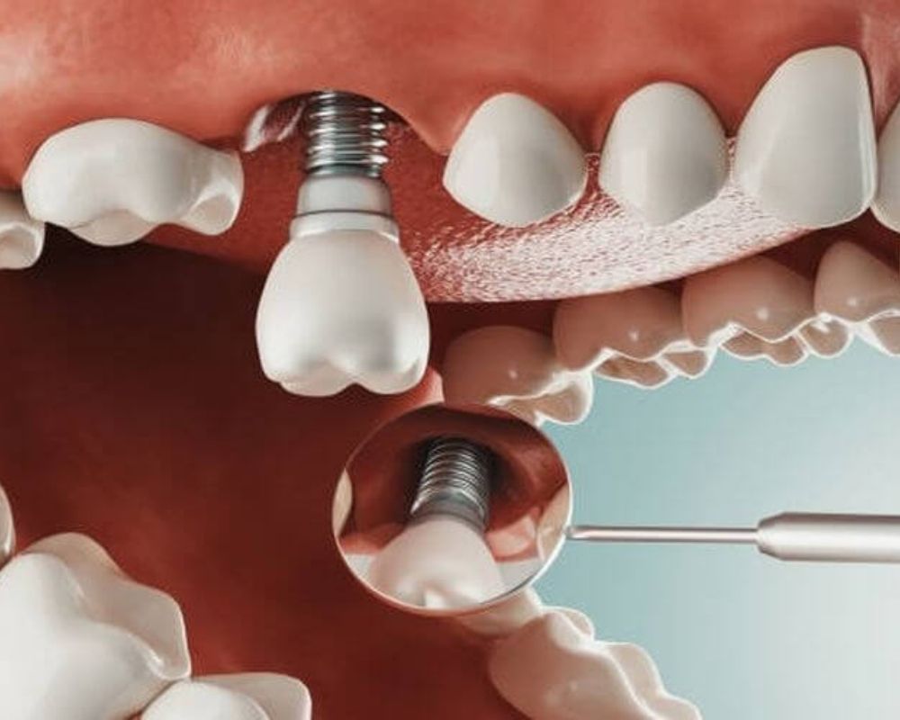 Bảng Giá Và Chi Phí Trồng Răng Implant Mới Nhất 2023