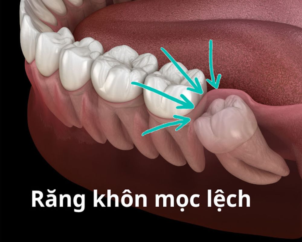 Răng Khôn Là Gì Có Nên Nhổ Răng Khôn Không